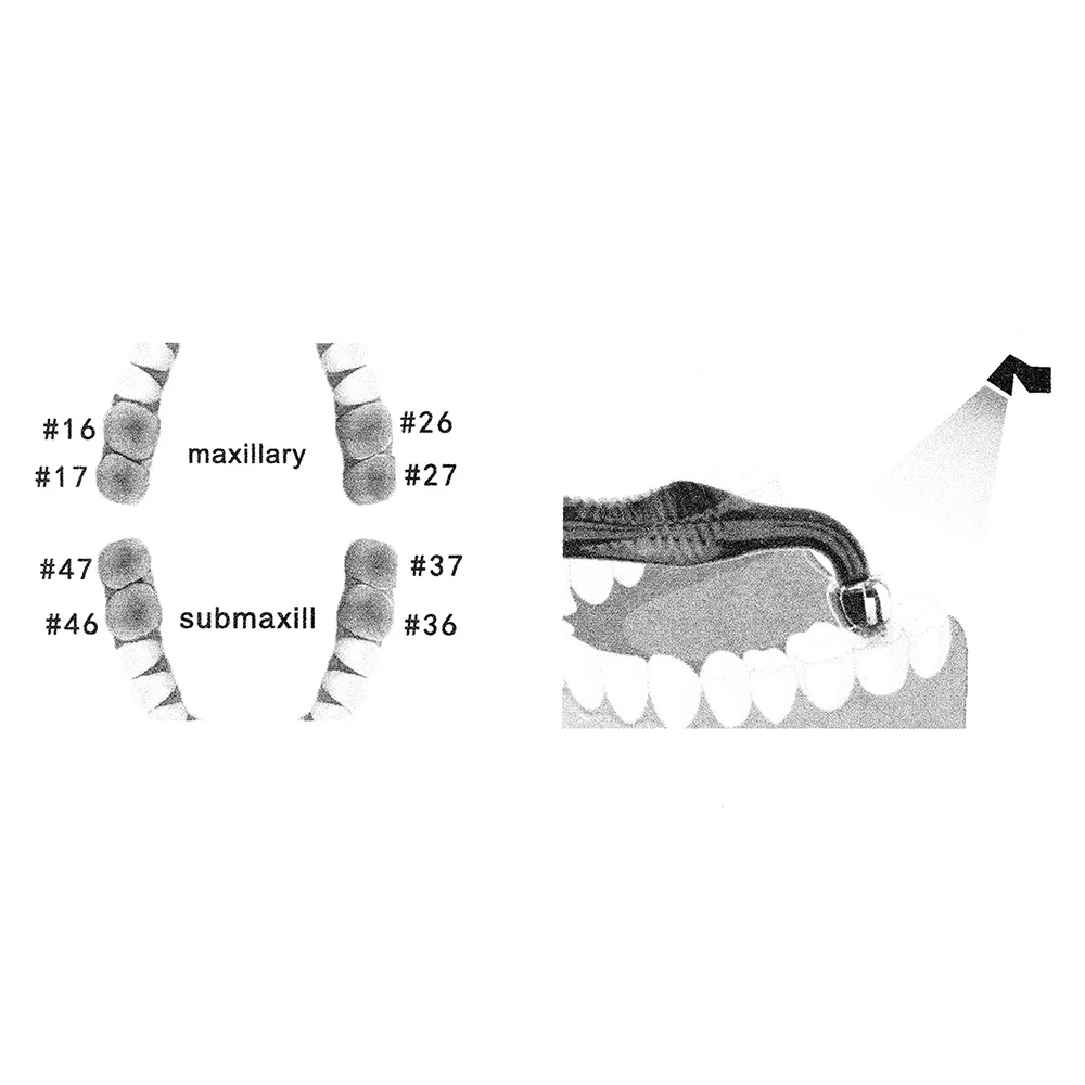 Dental Orthodontic Posterior T - 3D Printing Orthodontics recension och pris